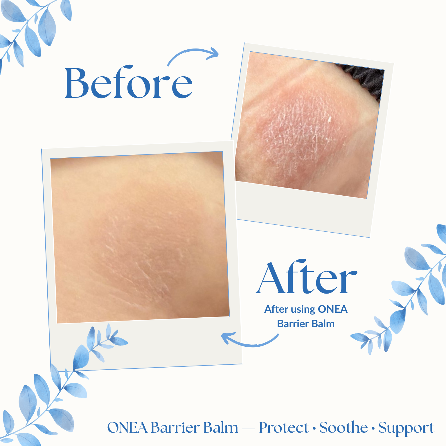 Complete Eczema-Prone Skin Care