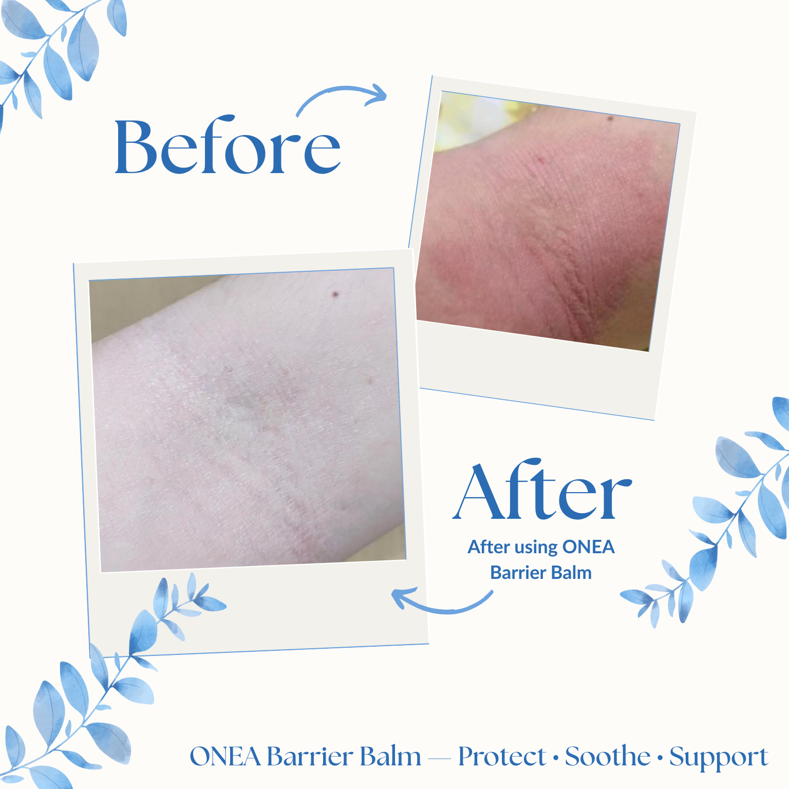 Complete Eczema-Prone Skin Care